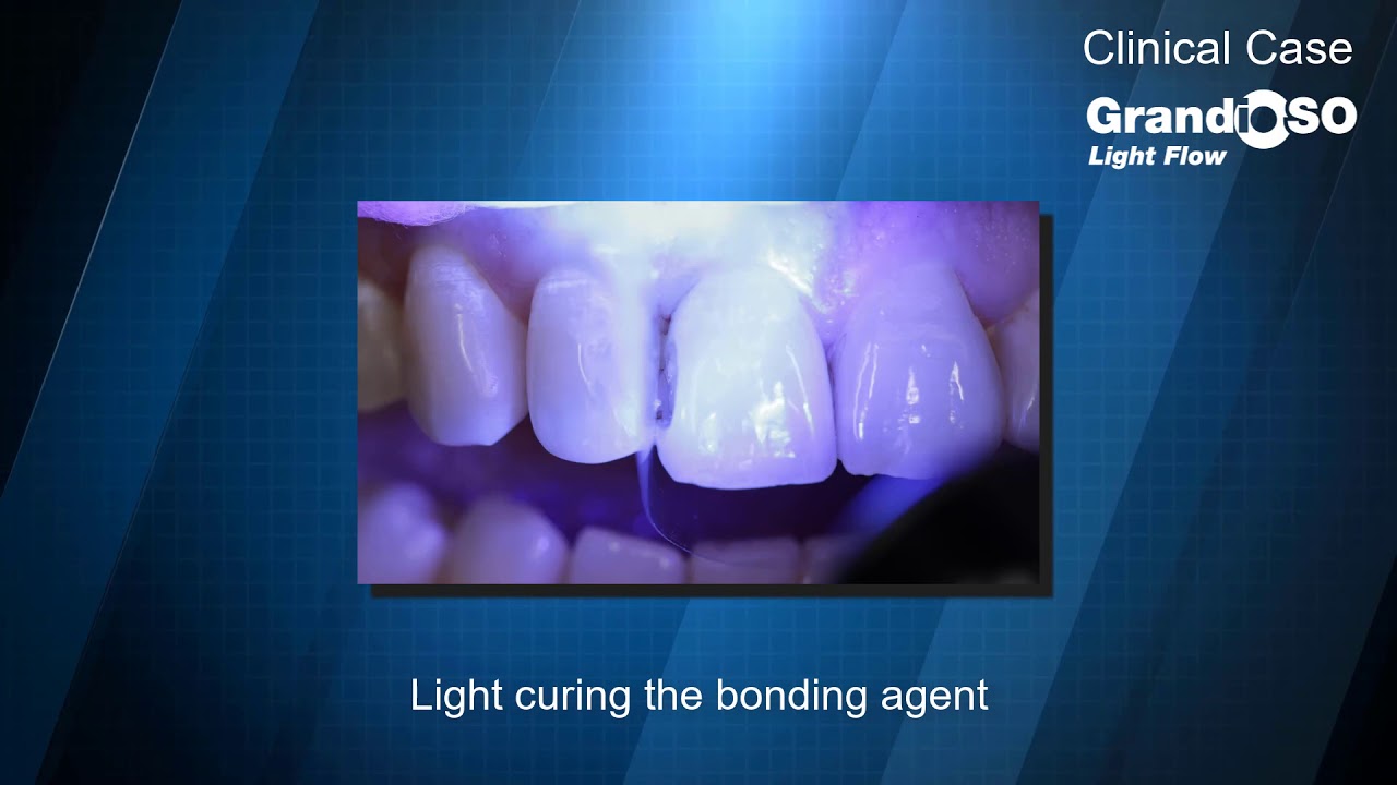 Clinical Tip:   GrandioSO Light Flow Clinical Case