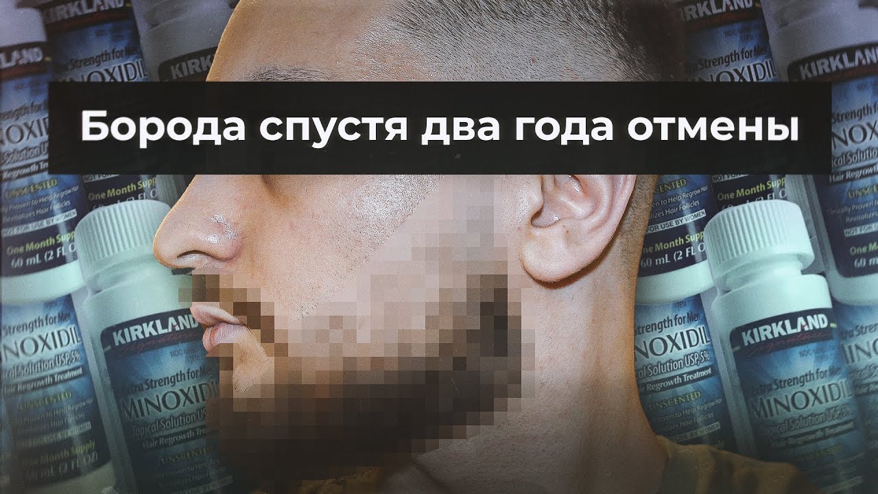 Борода спустя два года после отмены миноксидила