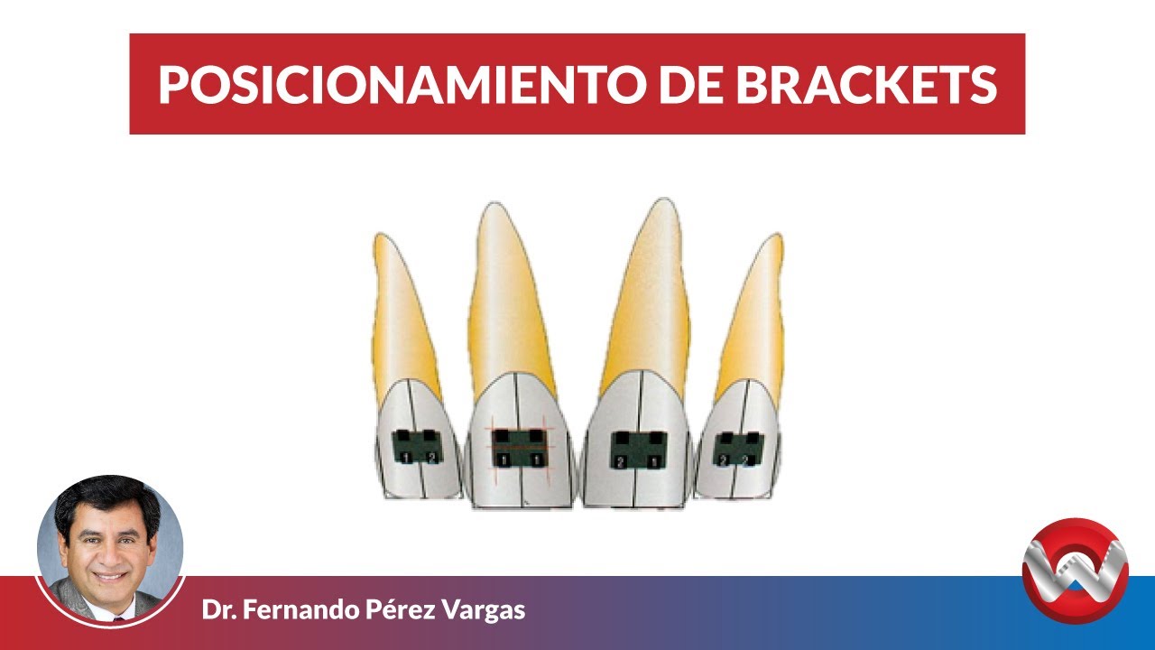 Posicionamiento de Brackets