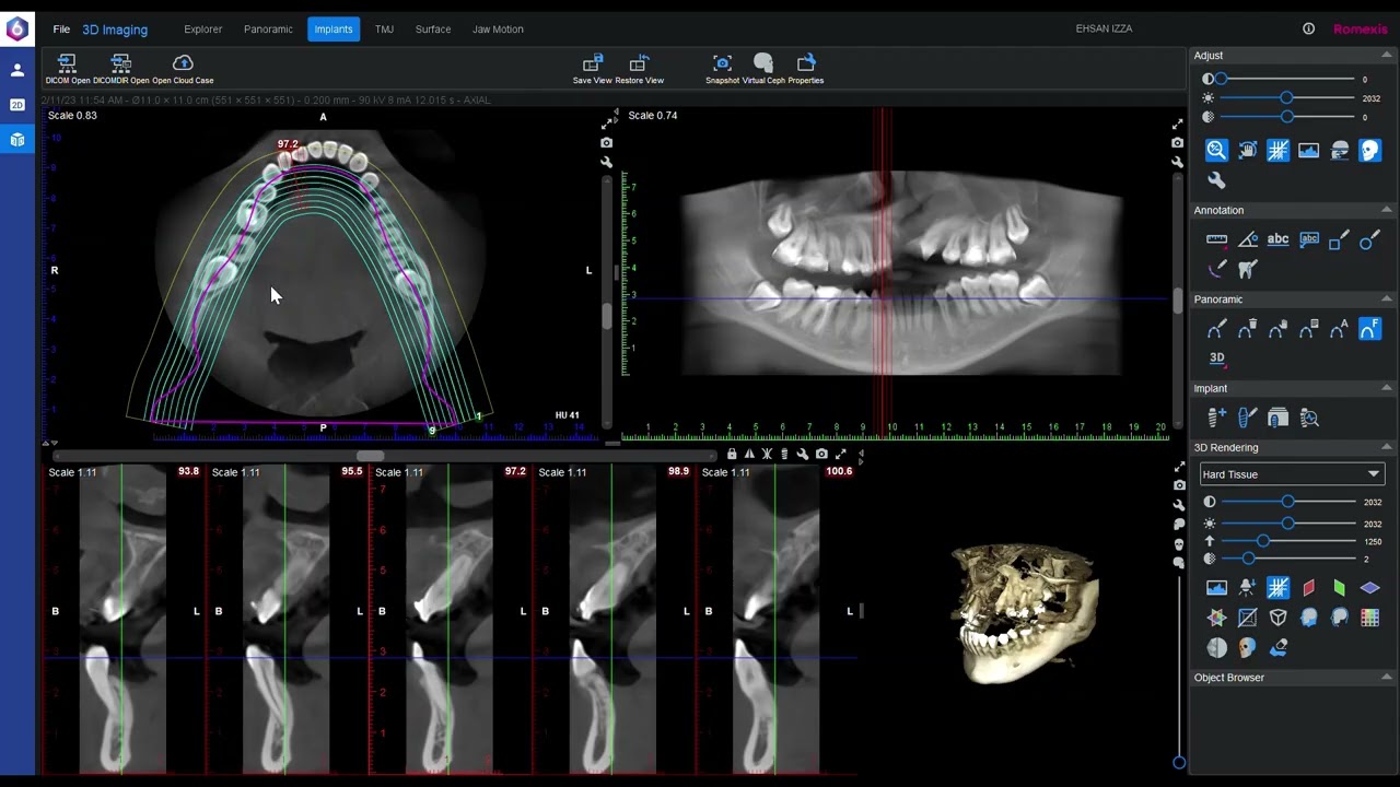 How to map the Inferior Alveolar Nerve on CBCT