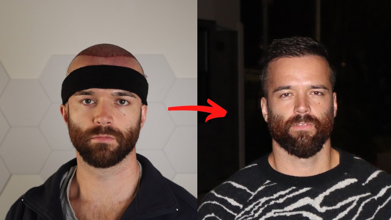 My 6 Month Hair Transplant Update