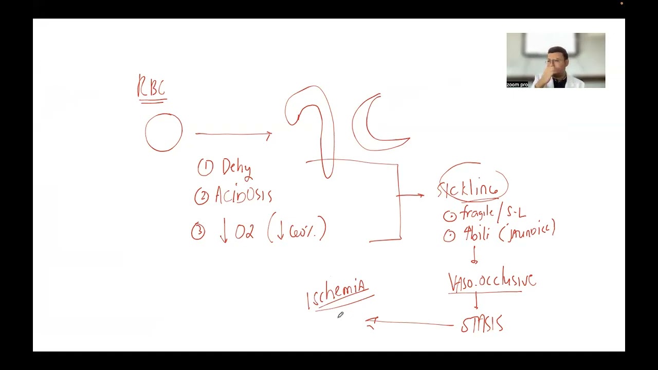 Sickle Cell Anemia