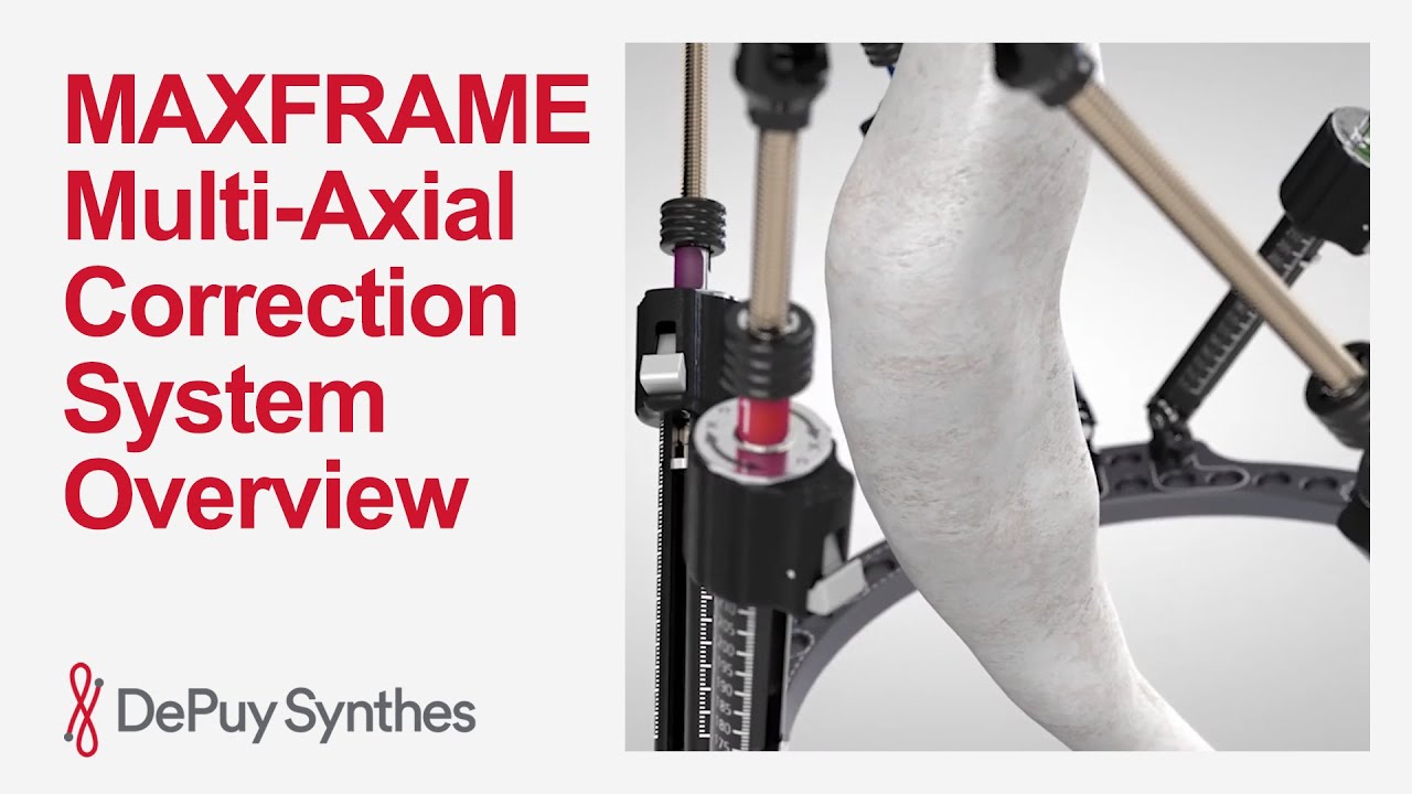How Does the MAXFRAME Multi-Axial Correction System Work for Deformity Correction? | DePuy Synthes