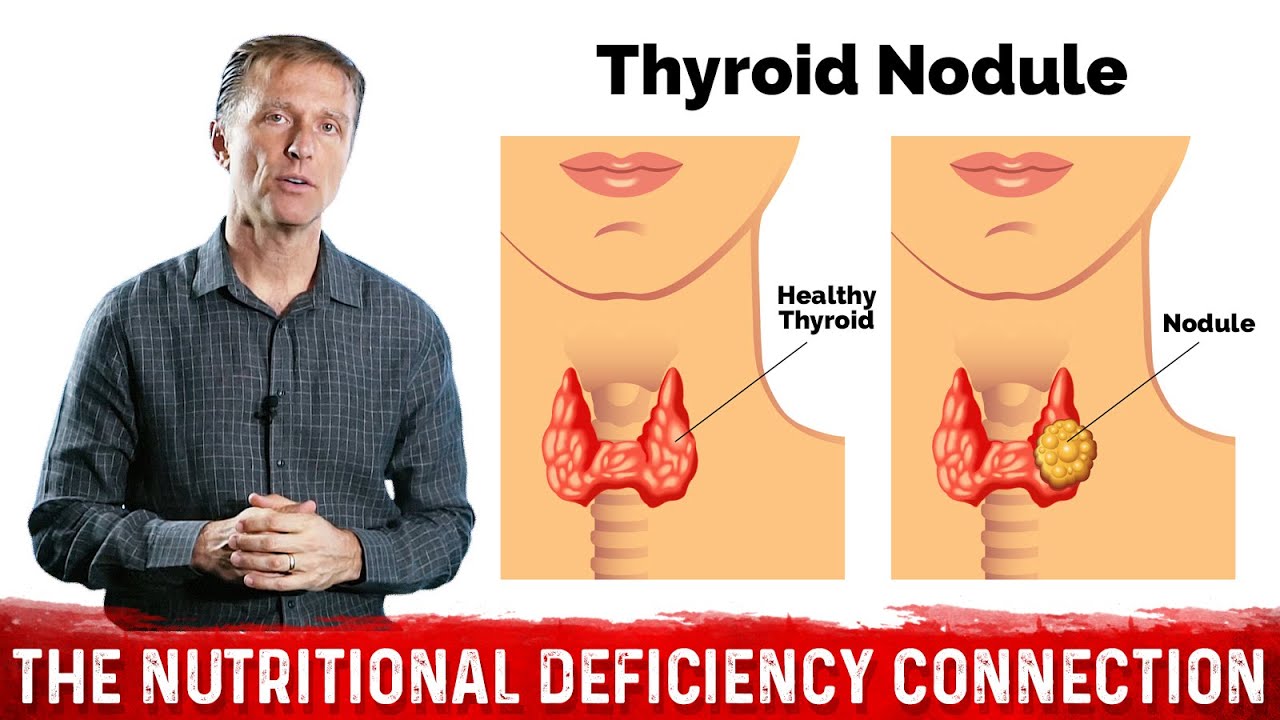 What's Behind Thyroid Nodules? Thyroid Disorders & Selenium Deficiency &ndash; Dr.Berg