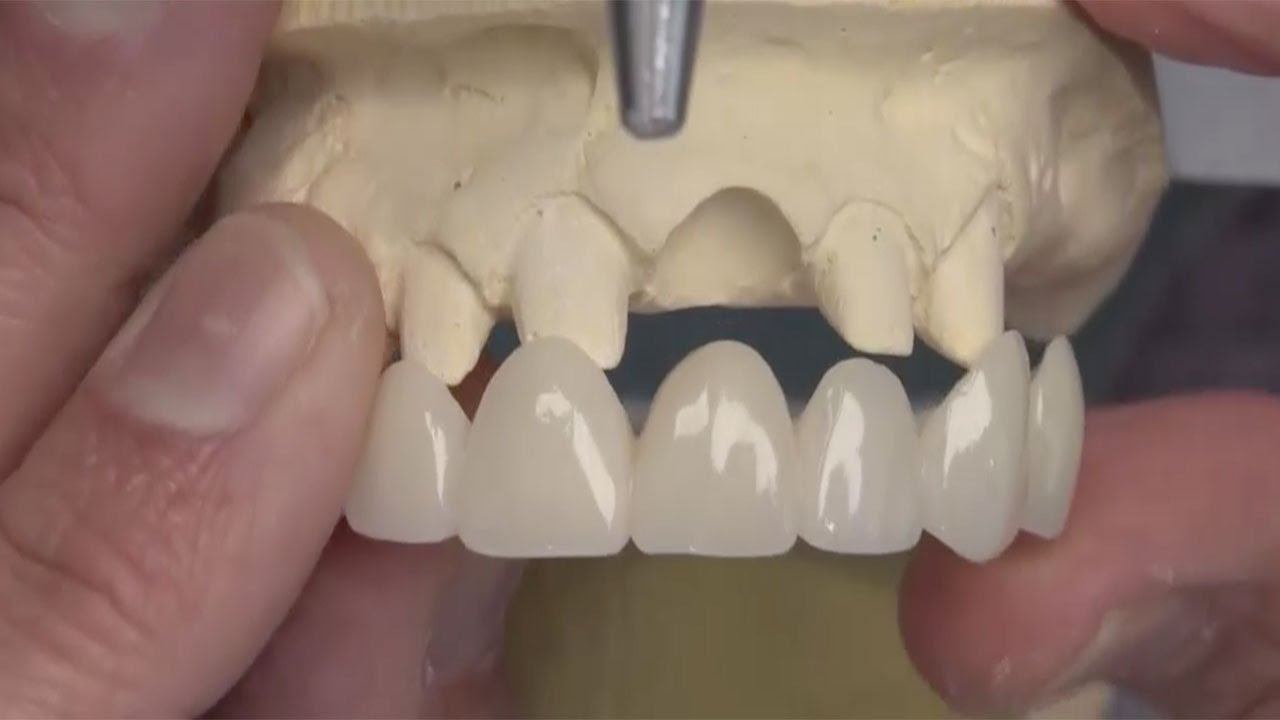 Chairside Live Episode 28: Ovate Pontic Sites With BioTemps® Provisionals