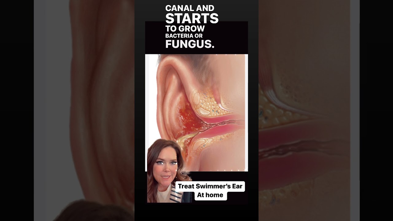 How to treat #swimmersear at home! DIY #homeremedy for Otitis Externa