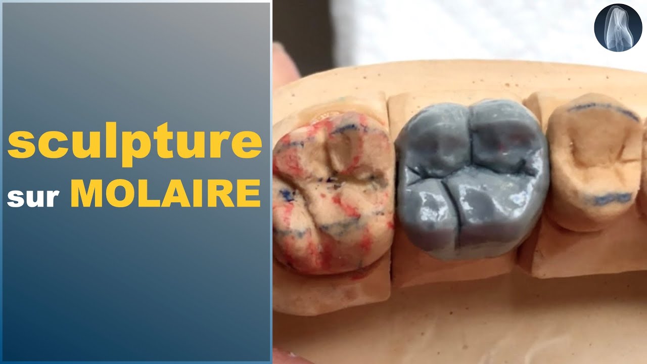 Apprenez à sculpter une molaire maxillaire en cire ✨ Étape par étape avec lignes de transition !