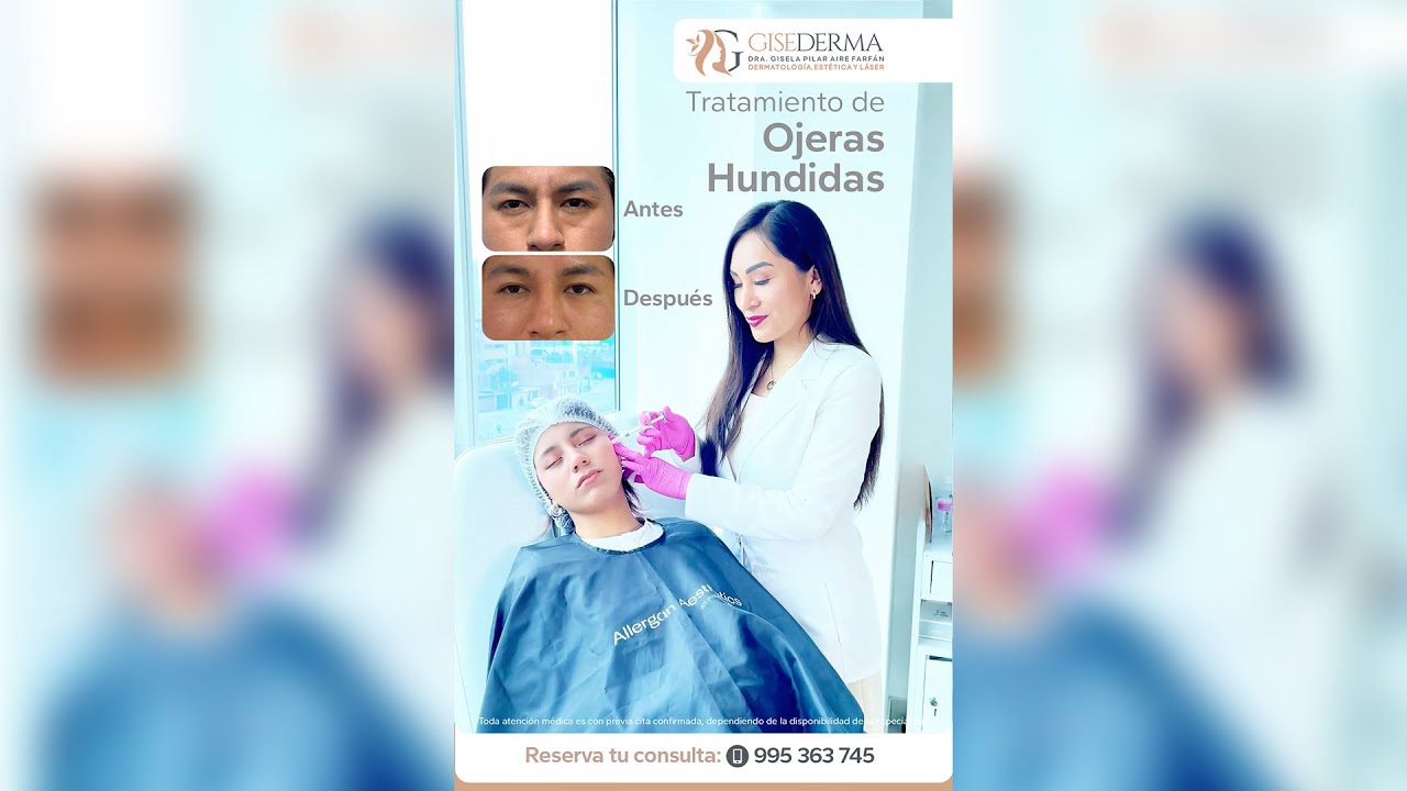 🥺¿Tienes ojeras hundidas y quieres lucir una mirada rejuvenecida?👁️👁️- Dra. Gisela Pilar Aire Farfán