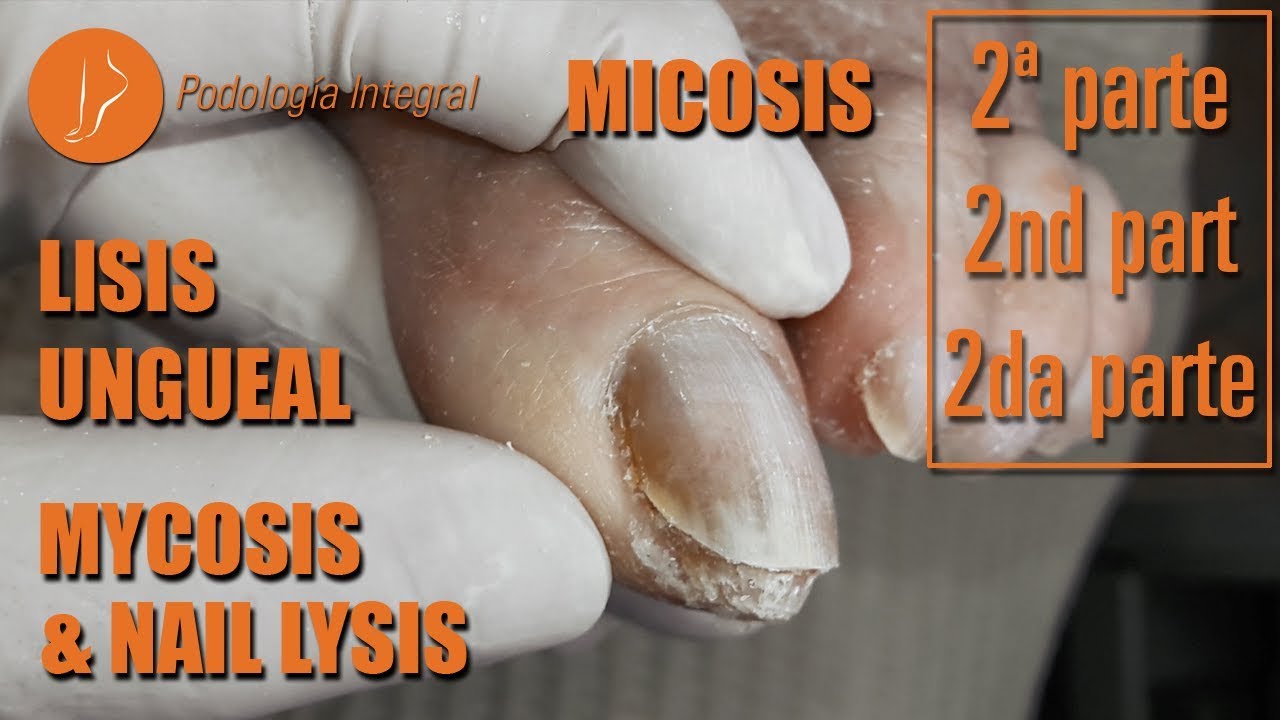 Mycosis and nail lysis (Part 2) #podology #asmr