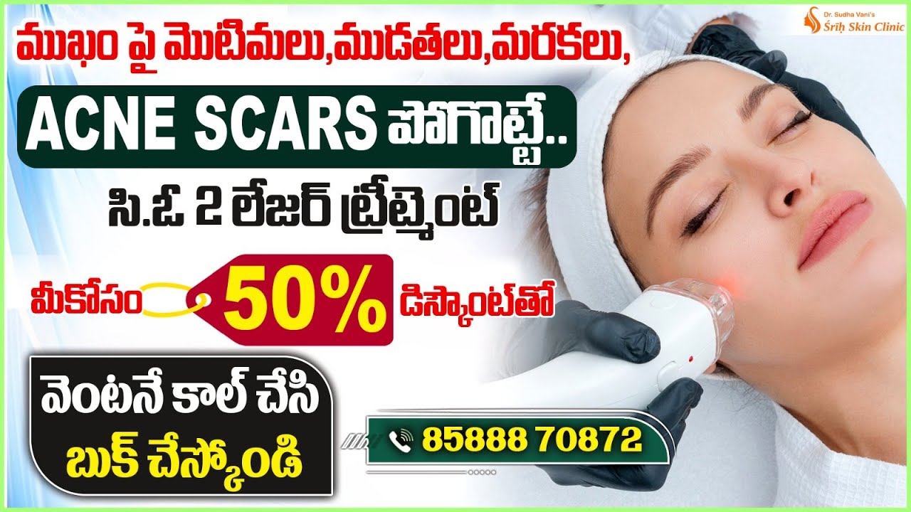 How to Remove Acne Scars and Dark Spots || Laser Treatment for Acne Scars || Shri Skin Clinic
