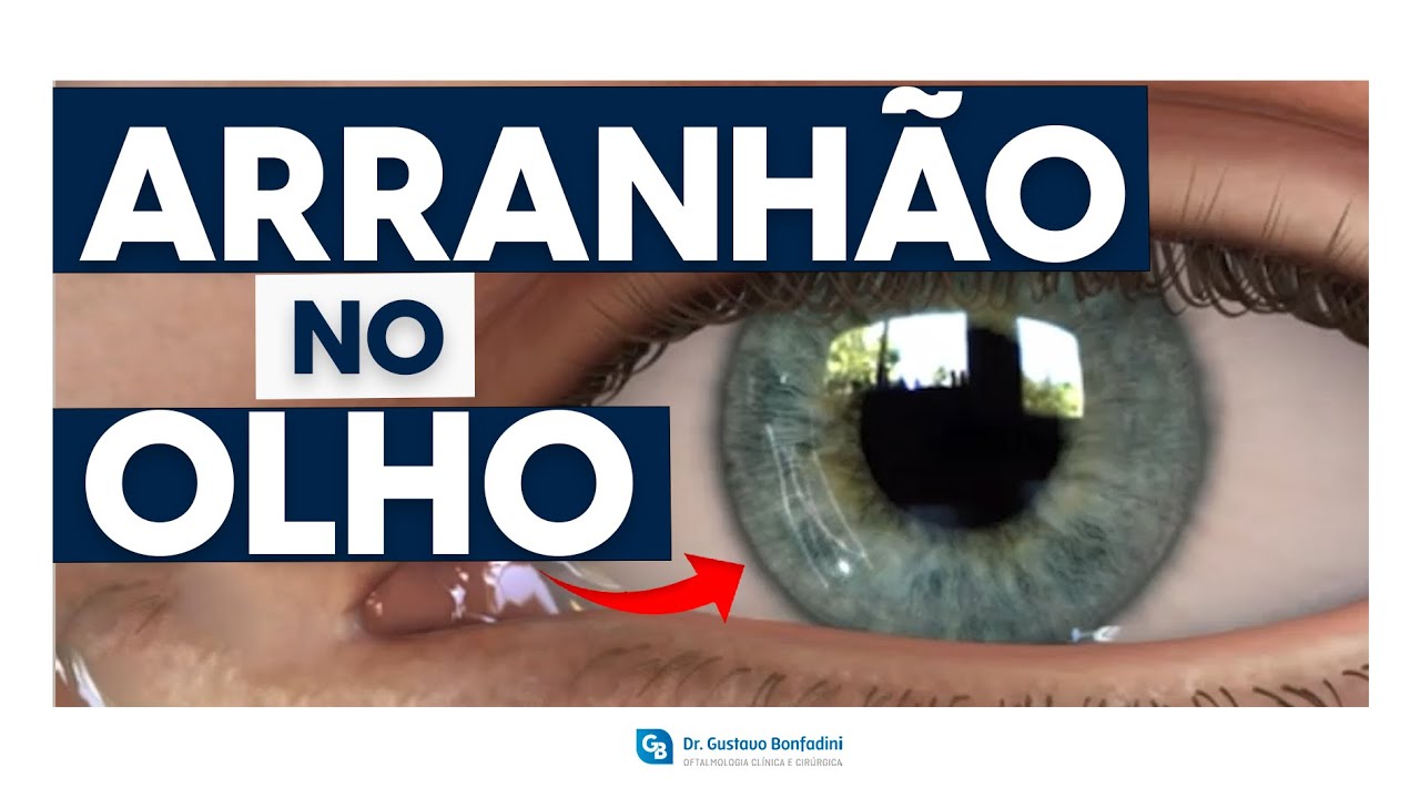 Abrasão da córnea - Dr. Gustavo Bonfadini