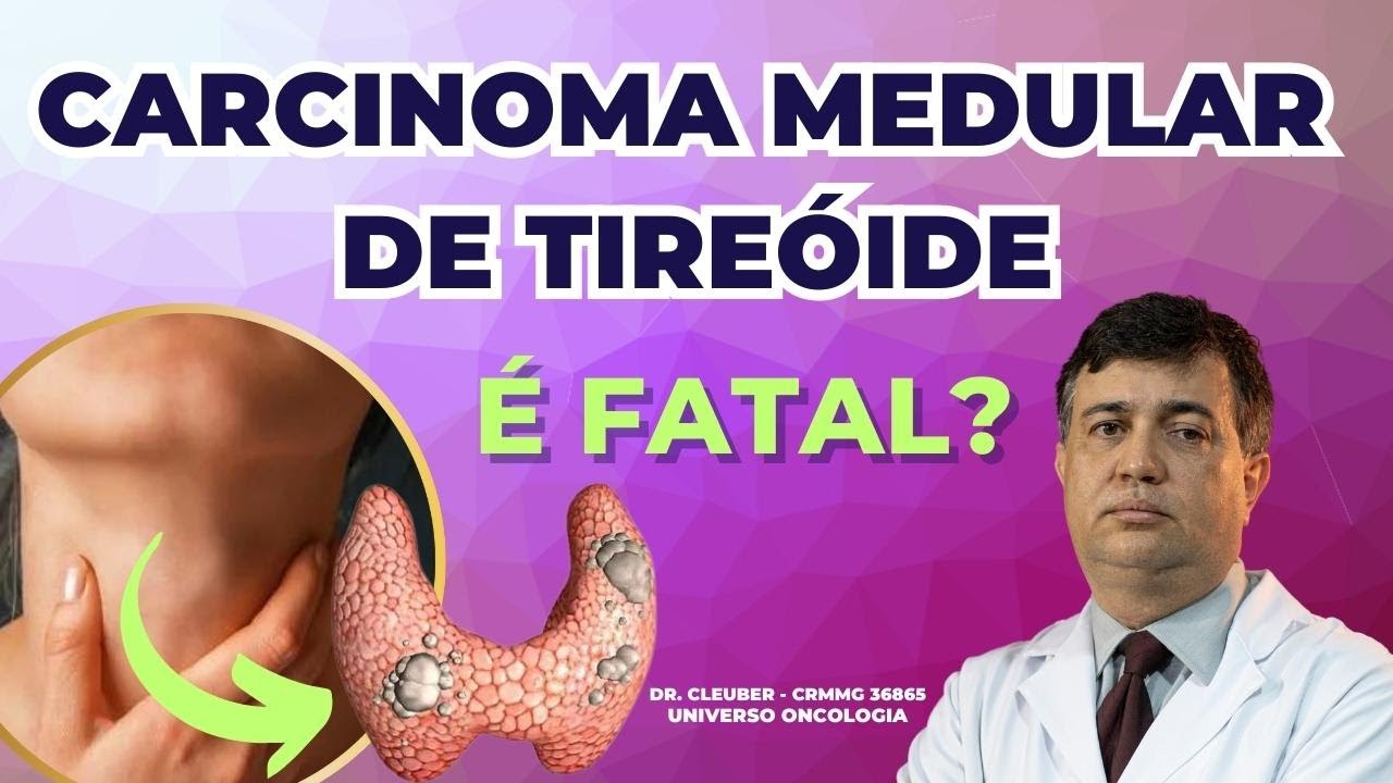 Câncer de Tireóide MEDULAR, é FATAL? Descubra!