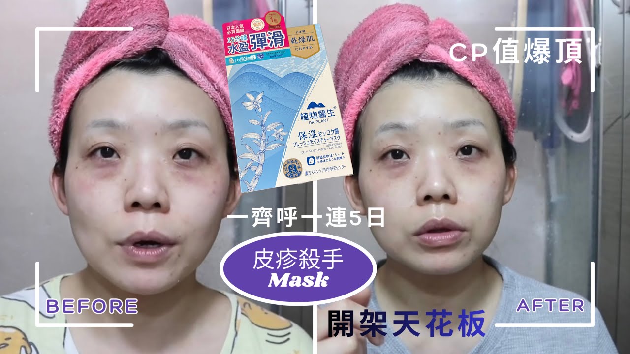 回到2024年：一齊同我呼一連5日皮疹殺手mask🥰開架天花板？！呼完爆水🤔？$100以下（全自購）￼