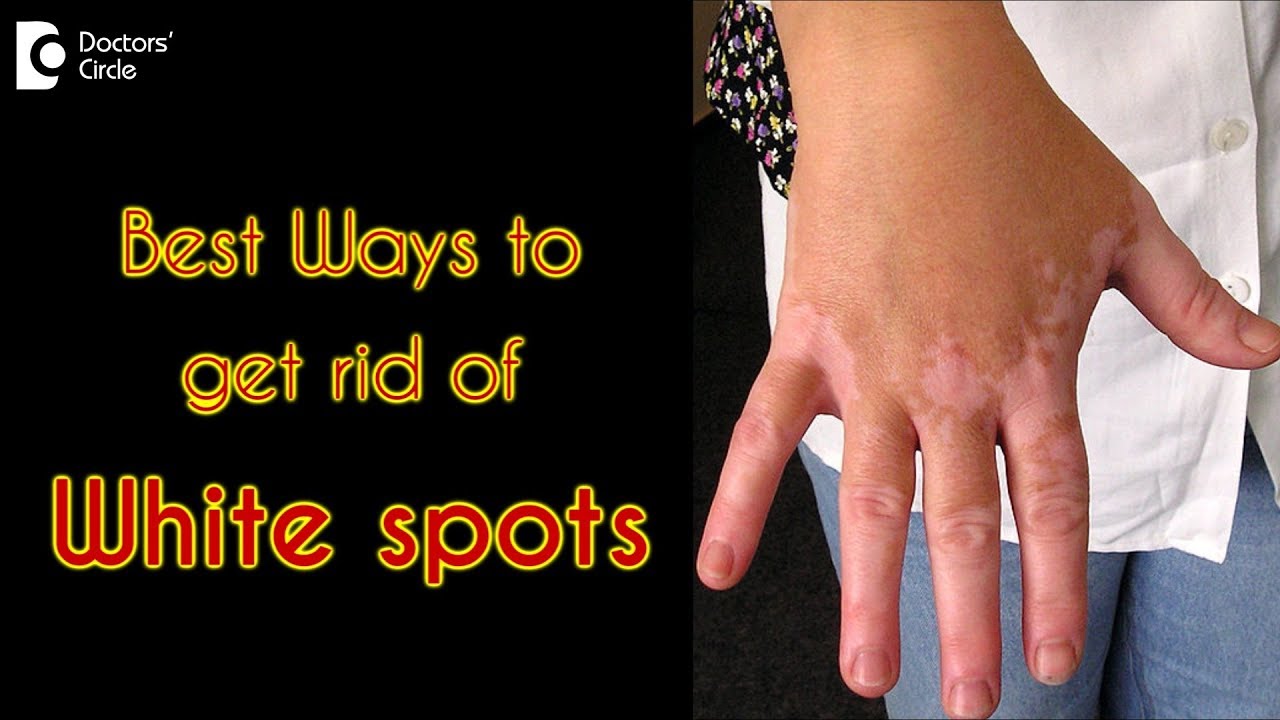 How to treat white spots on the skin? - Dr. Rasya Dixit