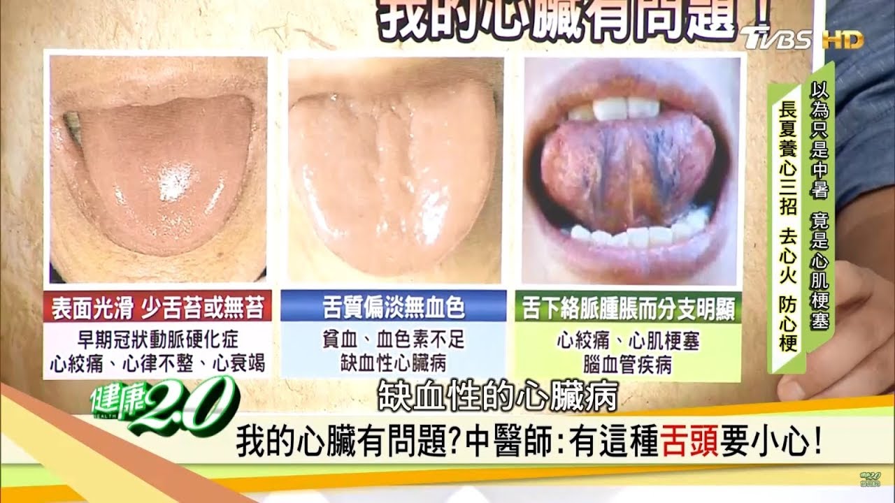 養心零嘴「山楂肉桂丸」這樣吃！從「舌頭」看你的心臟有沒有問題？！健康2.0