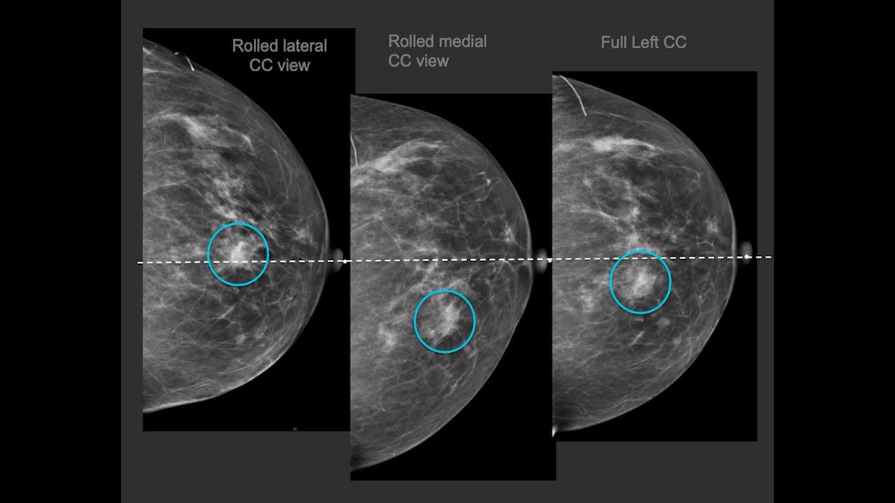 Diagnostic mammography