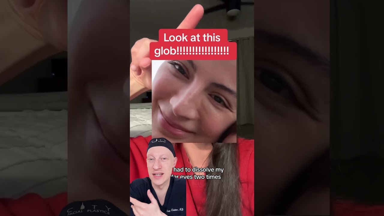 Watch THIS Before You Get Undereye Filler!