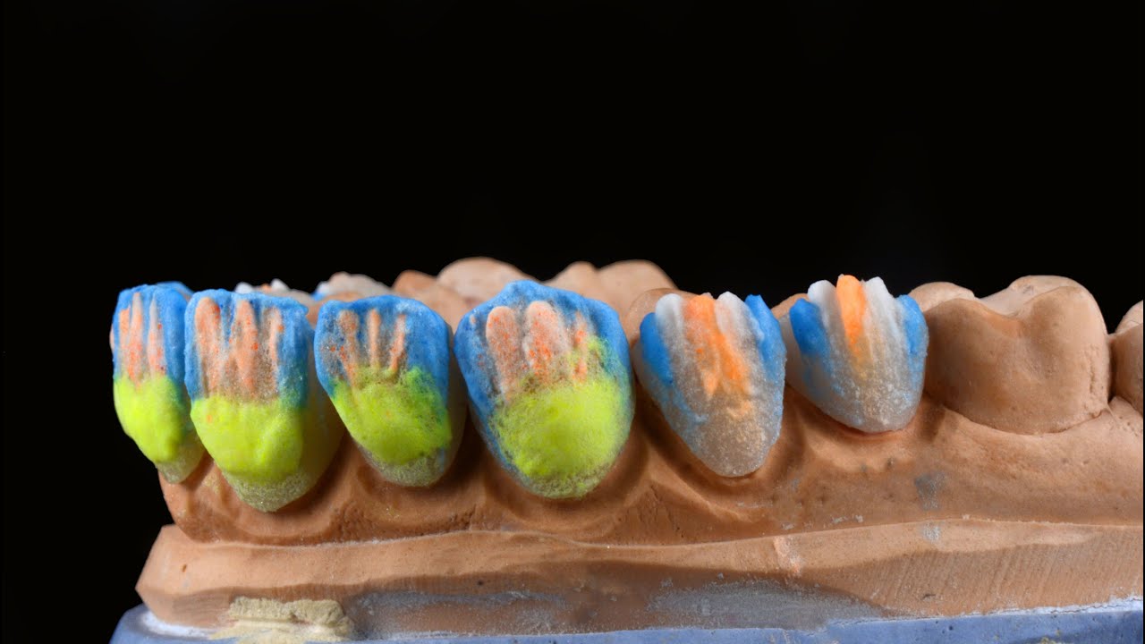 Laboratory Layering Art for Case done At Bay Dental