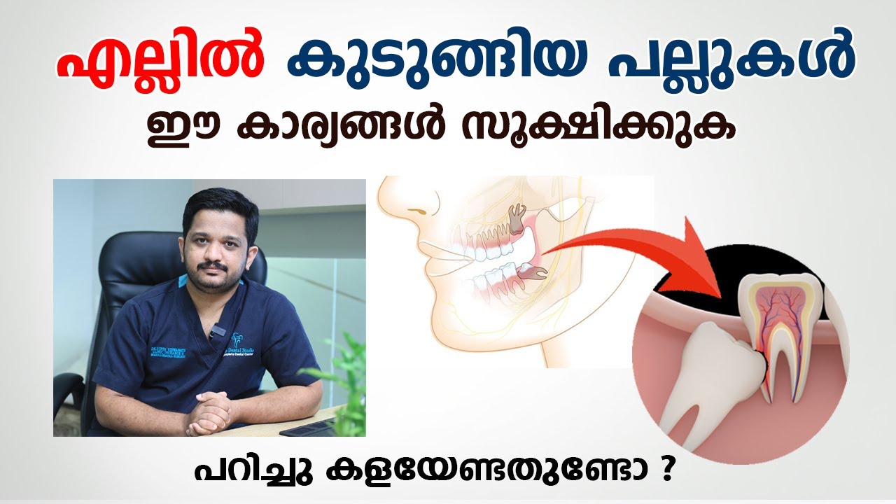 എല്ലിൽ കുടുങ്ങിയ പല്ലുകൾ പറിച്ചു കളയേണ്ടതുണ്ടോ ? | Impacted wisdom teeth Dental care