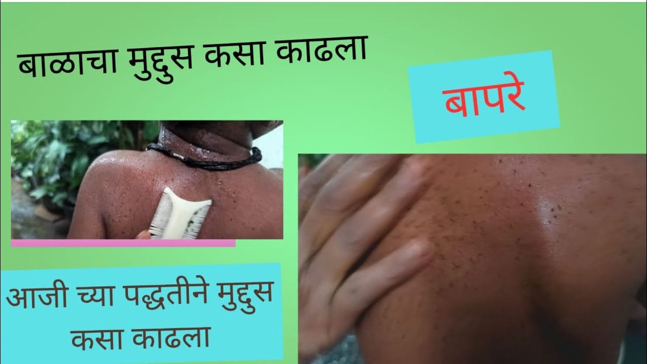 लहान मुलांचा मुद्दुस कसा काढायचा#👉👀🦠🦠