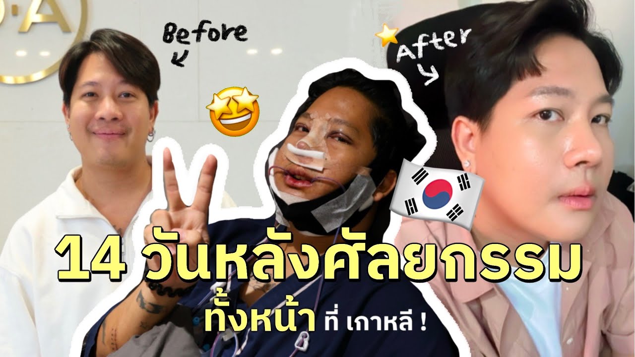 [173] อาการหลังผ่าตัดทำศัลยกรรม 14 วัน เป็นยังไงบ้าง บอกหมด ไม่เม็ด | phaztter