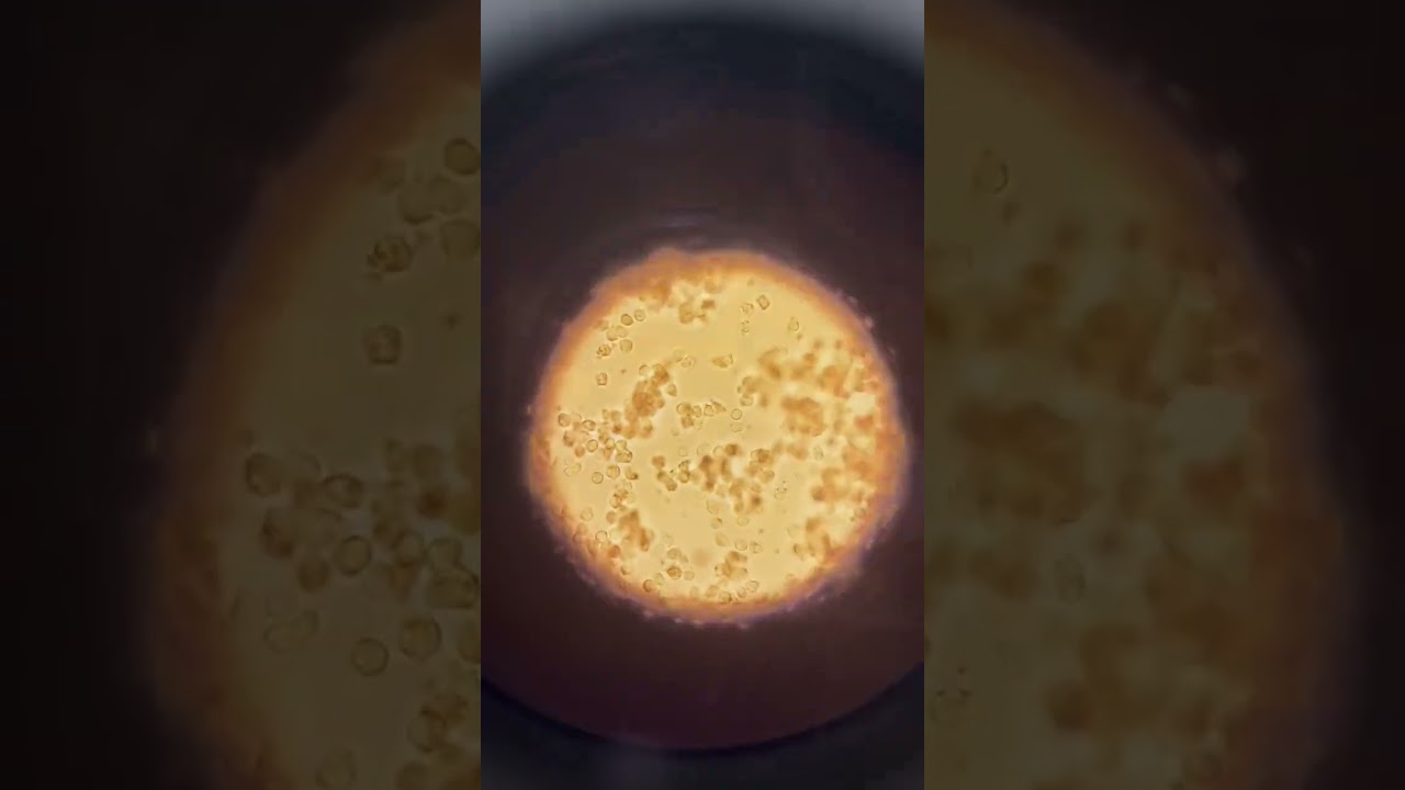 Peritoneal Fluid || Microscopic Examination