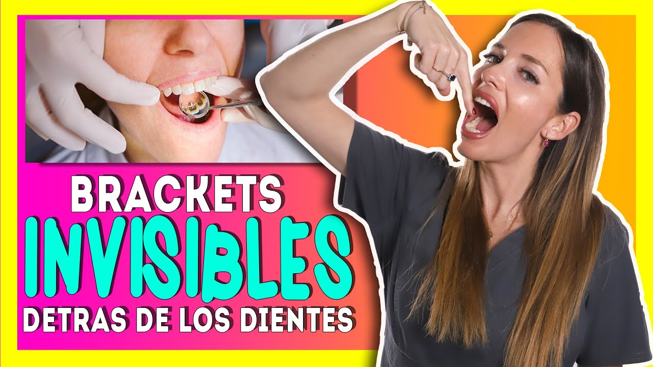 🔥Arregla tus 𝑫𝑰𝑬𝑵𝑻𝑬𝑺 𝑻𝑶𝑹𝑪𝑰𝑫𝑶𝑺 𝒔𝒊𝒏 𝑩𝑹𝑨𝑪𝑲𝑬𝑻𝑺 tradicionales. Ortodoncia LINGUAL con BRACKETS INVISIBLES