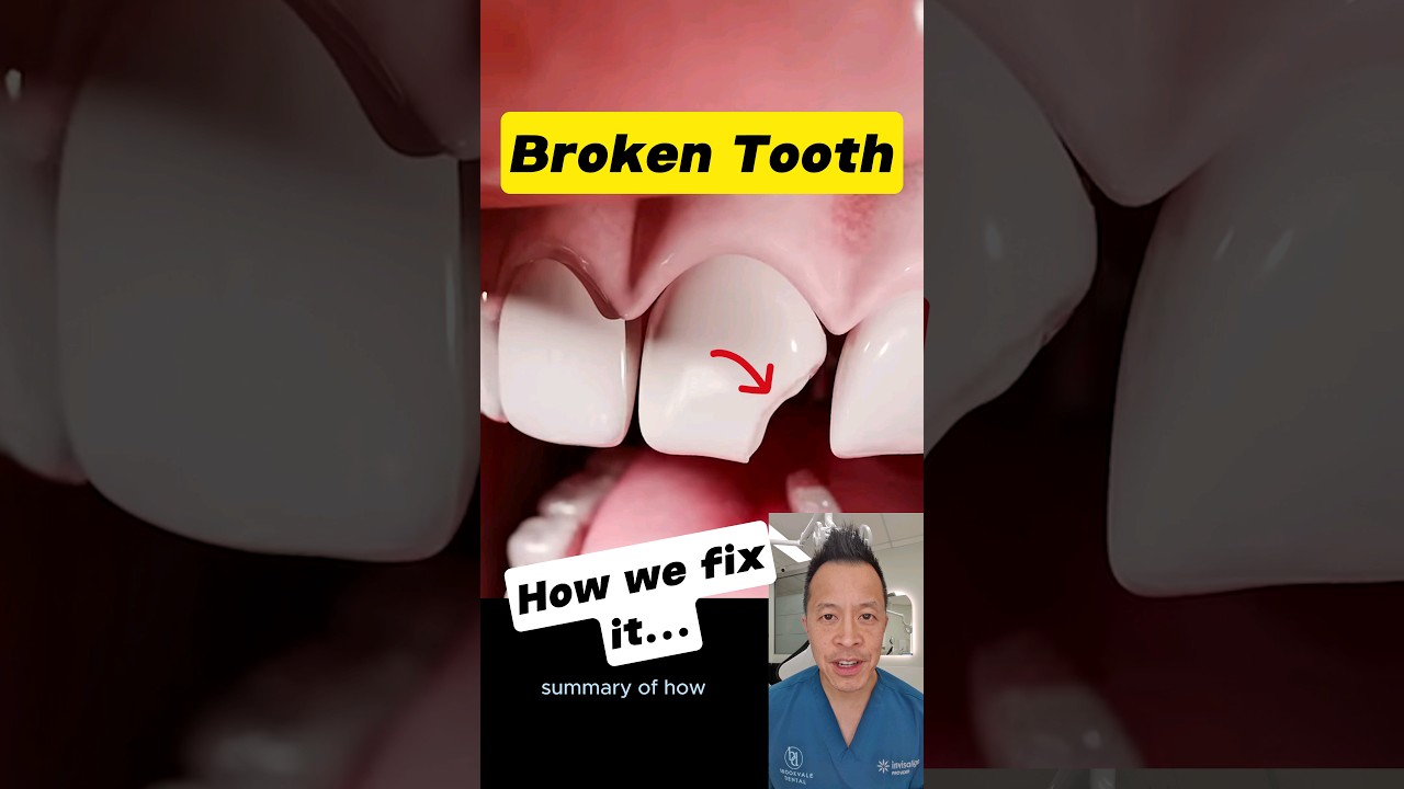 Broken Front Tooth? Here&rsquo;s How Dentists Restore Your Smile! #dentallan #dentist #shorts