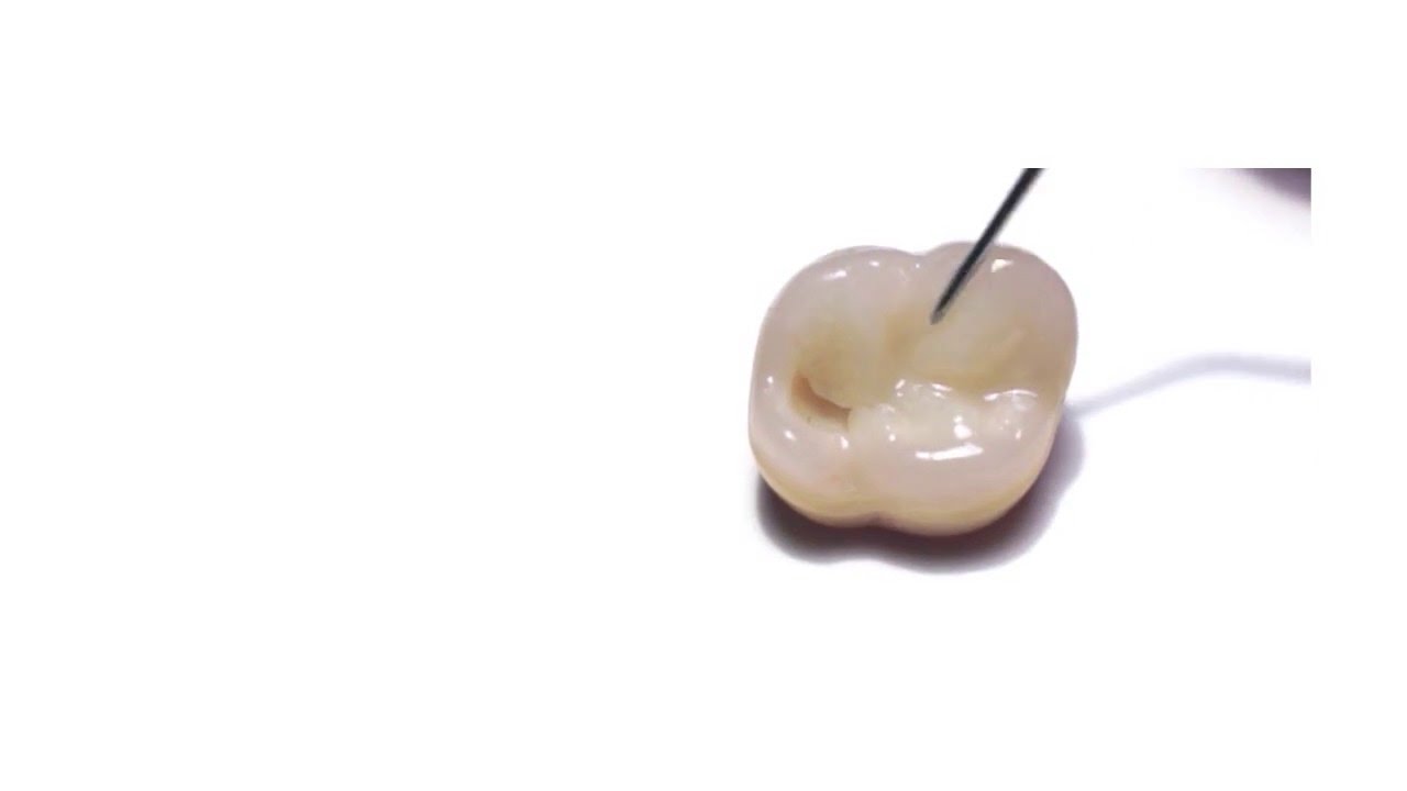 Posterior Composite Layering Technique | One shade | 5 Simple Steps