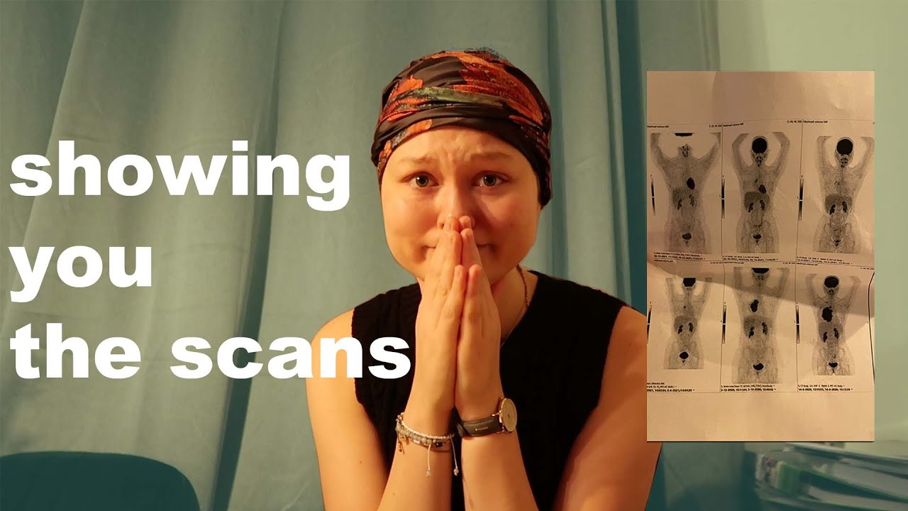 PET Scan Results: I'm Cancer Free !!!