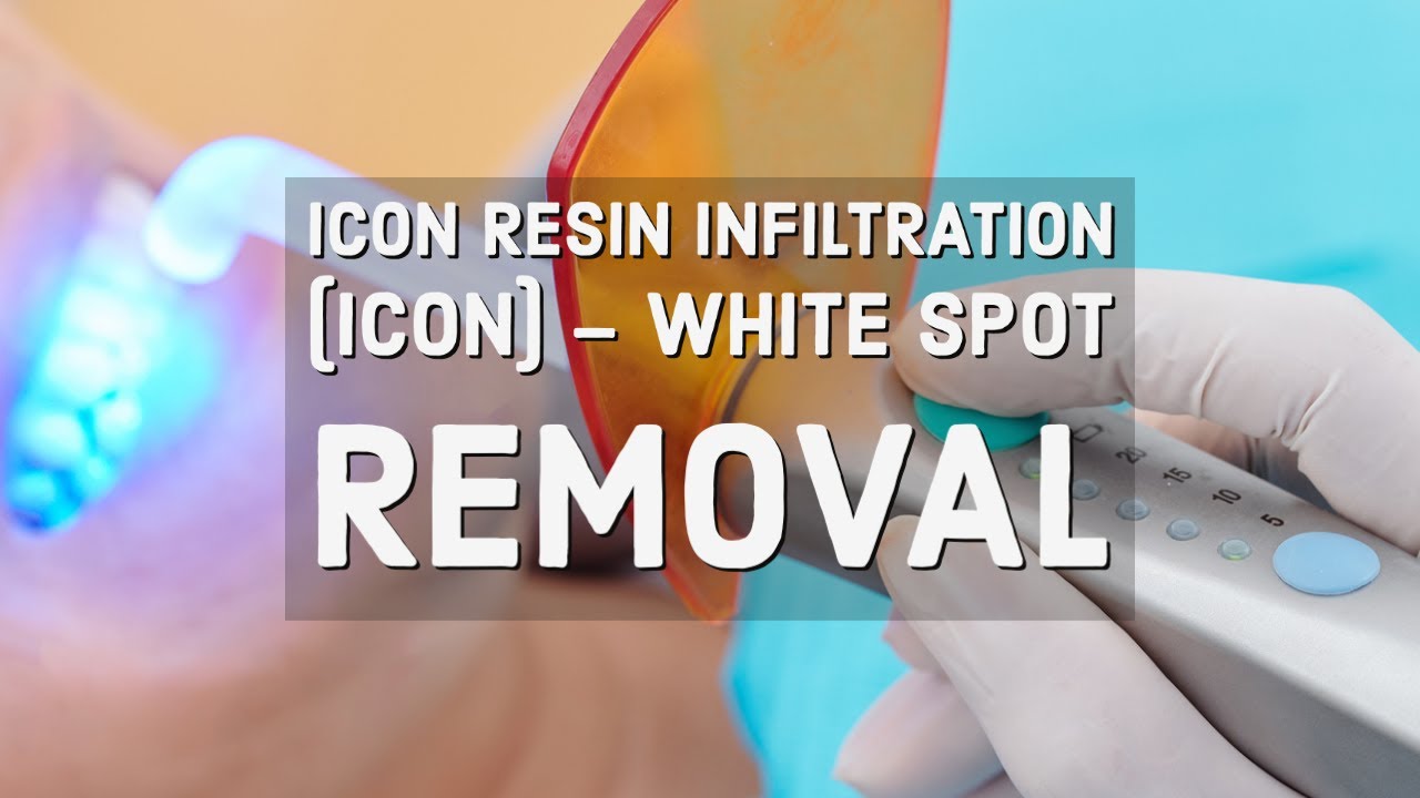 Icon Resin Infiltration (ICON) – White Spot Removal