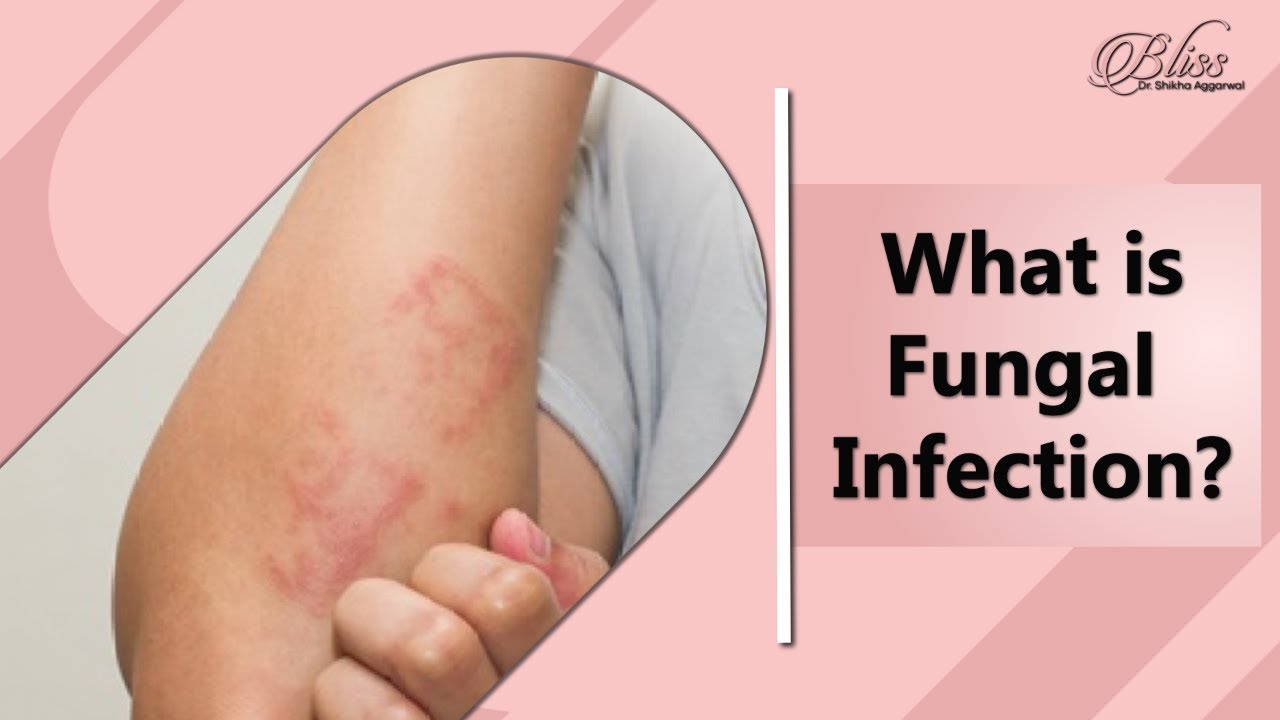 What is Fungal Infection | Types of Fungal Infection | Fungal Infection Treatment in Ludhiana