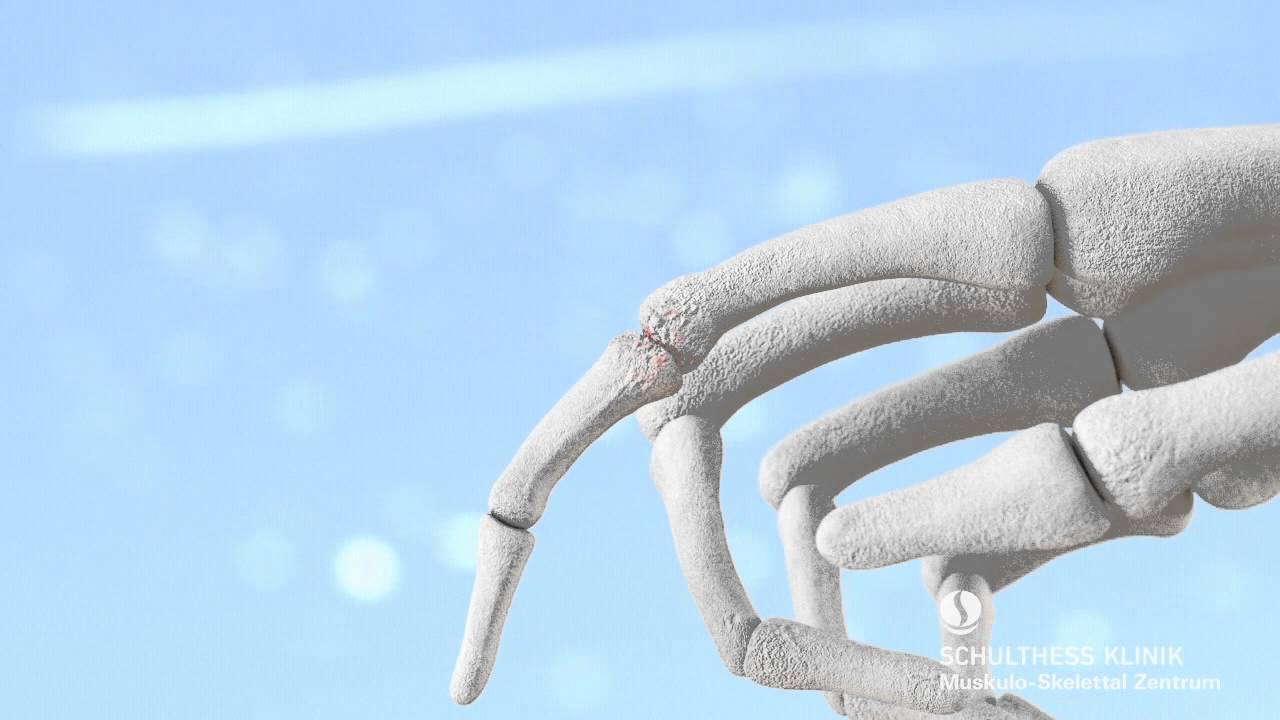 «Fingergelenksarthrose - Kunstgelenk» - Schulthess Klinik