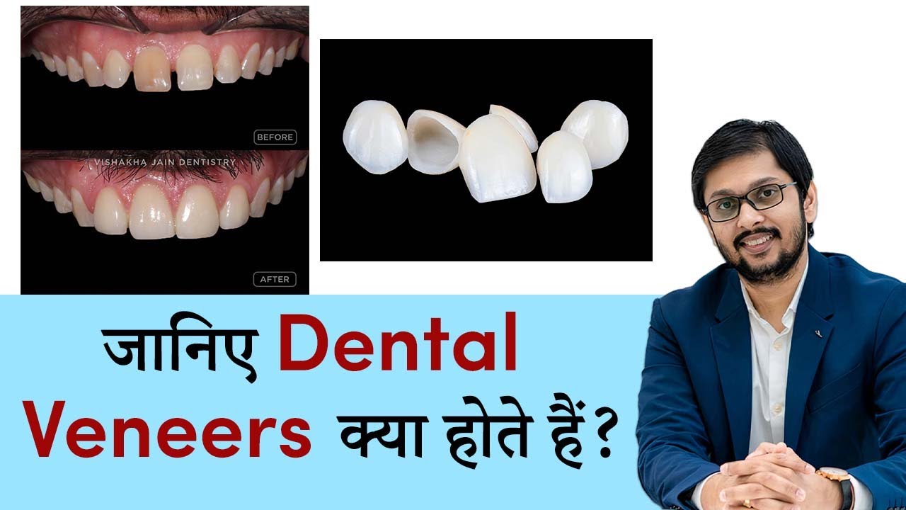 जानिए Dental Veneers क्या होते हैं?  - by Dr Ankit Khasgiwala | SERAPHIC DENTAL | INDORE