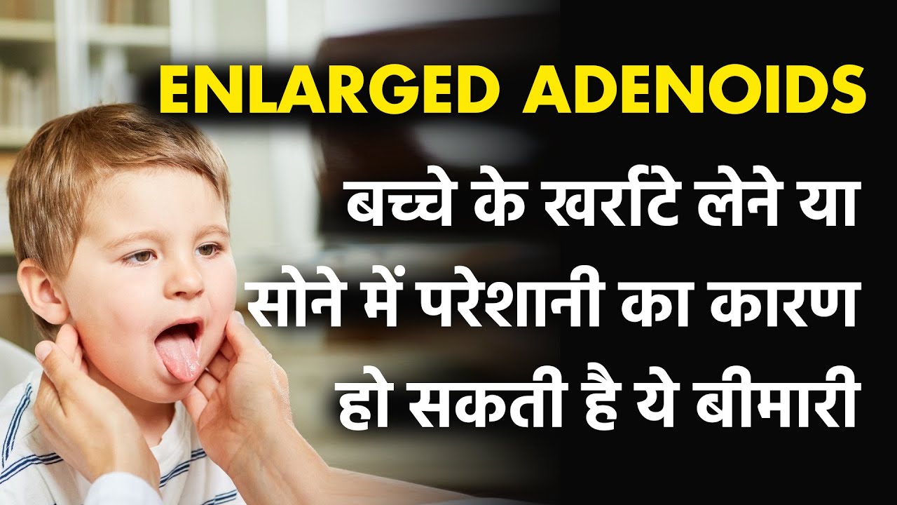 Top 5 Natural Remedies for Swollen Adenoids (Enlarged Adenoids)