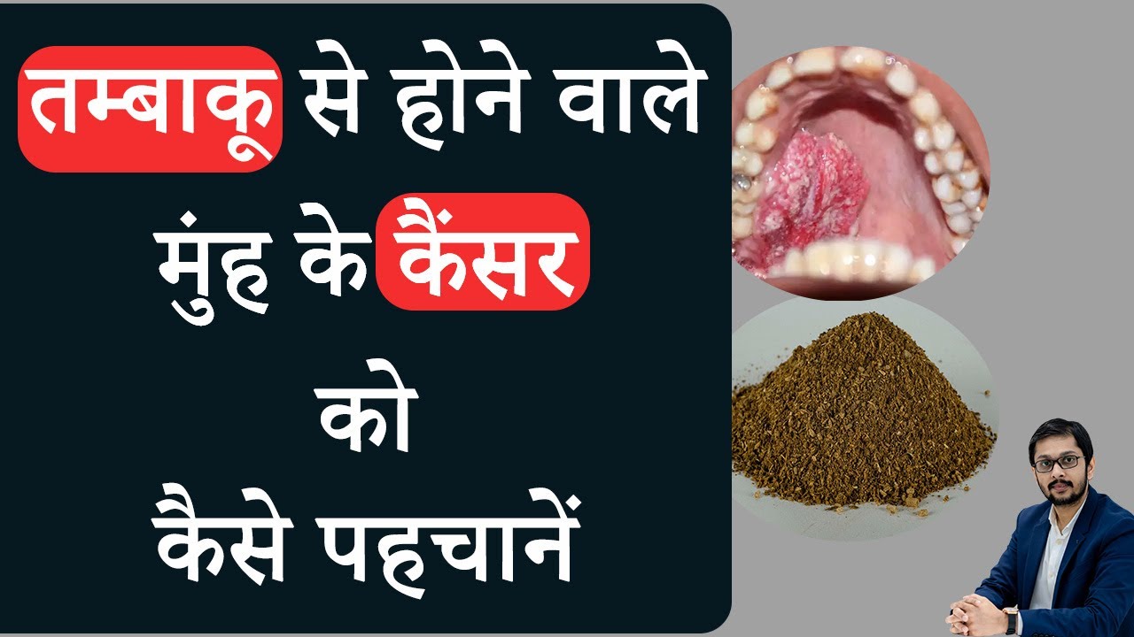 तम्बाकू से होने वाले मुंह के कैंसर की पहचान | मुंह के कैंसर से कैसे बचें | Tobacco mouth cancer