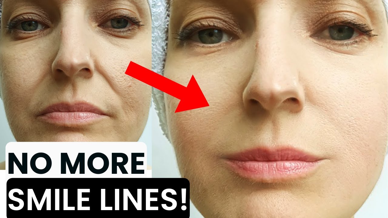 HOW TO GET RID OF SMILE LINES, NASOLABIAL FOLDS, MARIONETTE LINES, SMOKER LINES