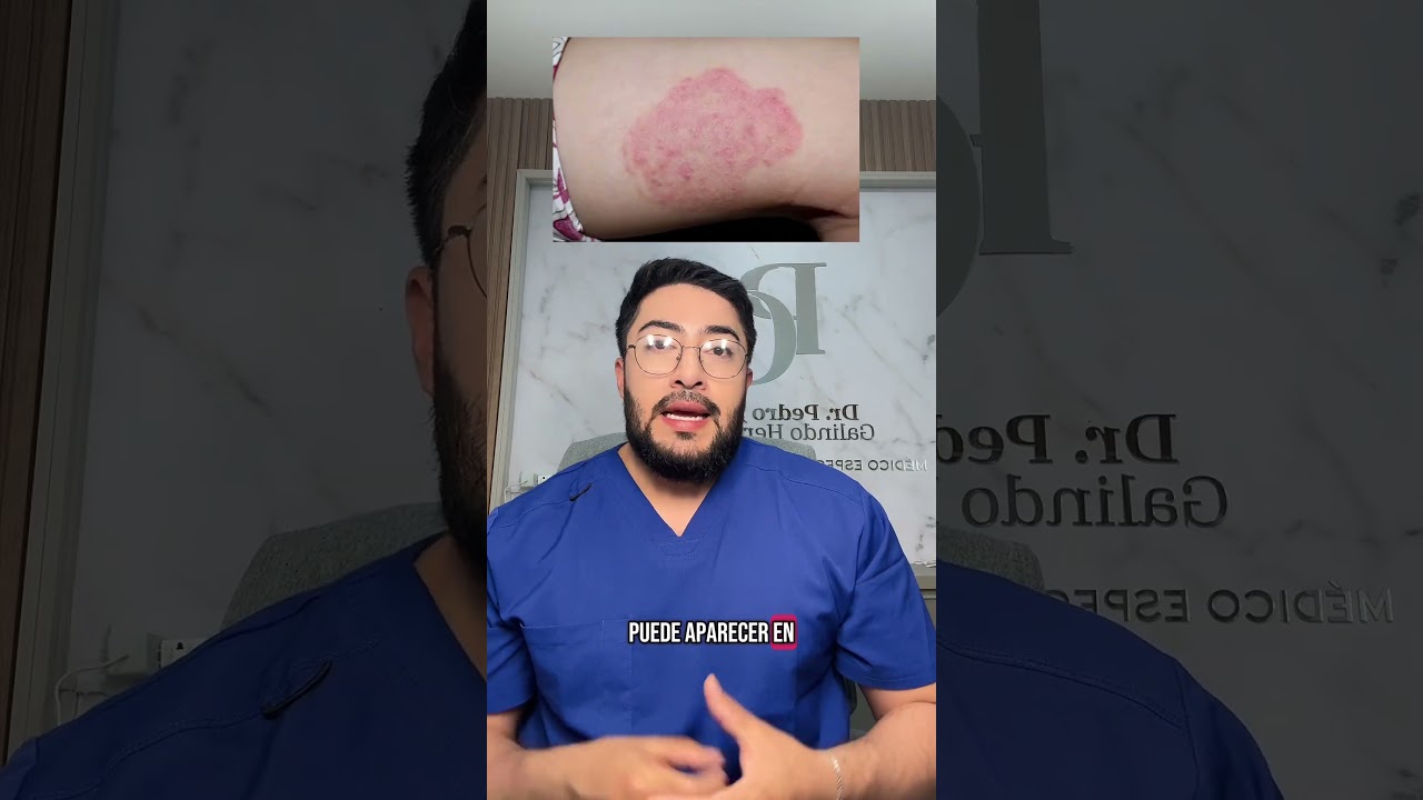 Ti&ntilde;a corporis, hongos en la piel #dermatologia #skincare #piel #dermatologo #dermatologia