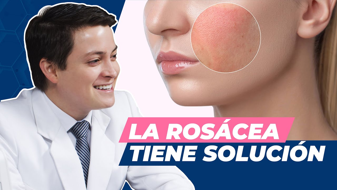Tratamiento láser para rosácea, cómo disminuirla y controlarla