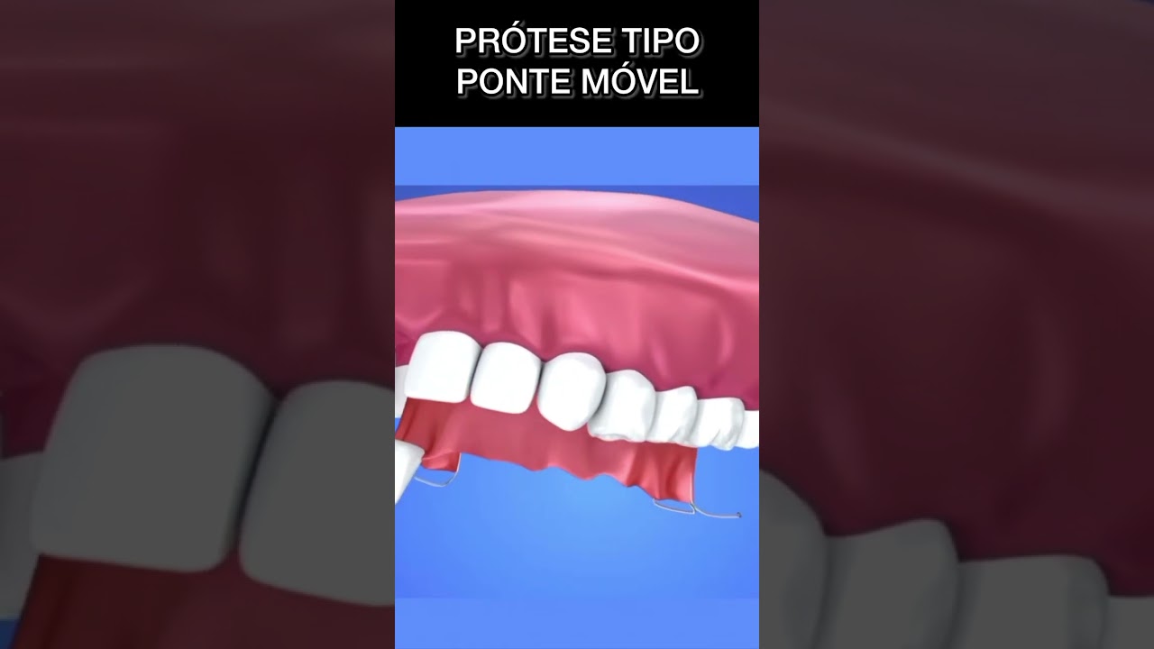 PONTE MÓVEL - prótese removível parcial 
