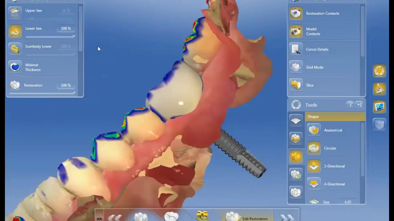 CEREC - SingleI Posterior Implant Crown (Screw-Retained)