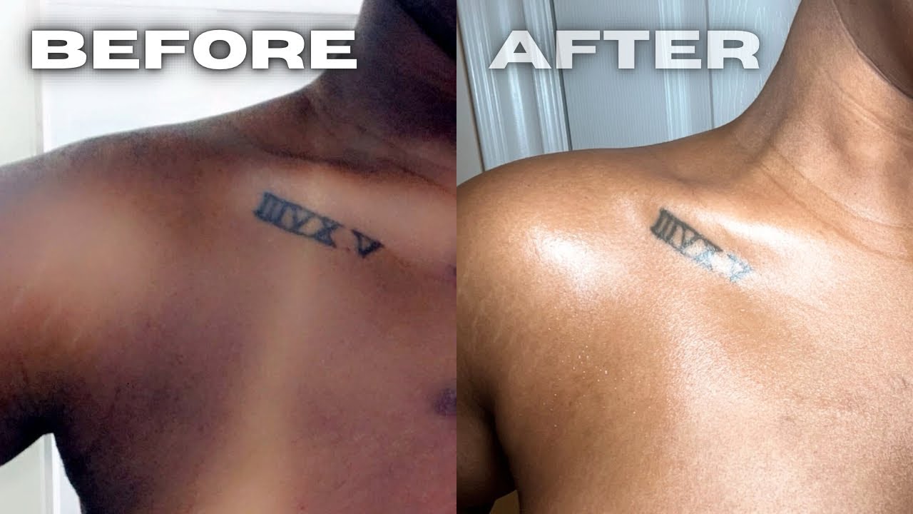 I DON’T WEAR SUNSCREEN *BODY HYPERPIGMENTATION & SUNBURN*
