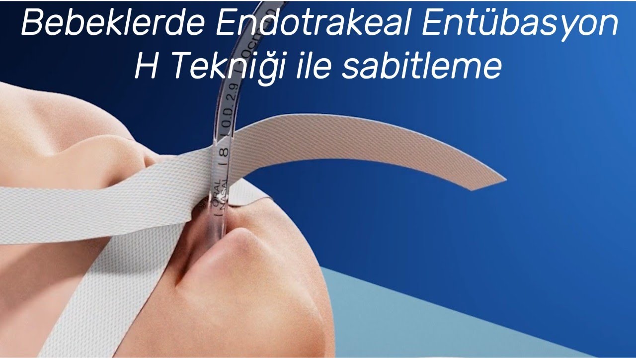 Bebeklerde Endotrakeal Entübasyon Sonrası H tekniği ile sabitleme