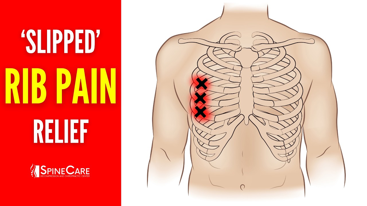 How to Fix a Rib Out of Place in SECONDS