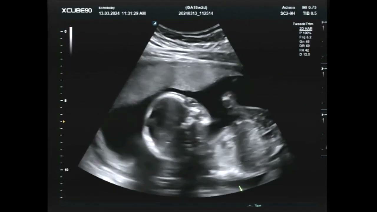Pretecho 18 Weken Zwanger Filmpje