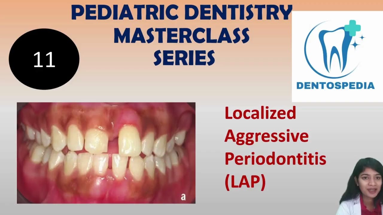 PD 11 Localized Aggressive Periodontitis Explained | Pediatric Dentistry Masterclass #AFK #ORE #MFDS