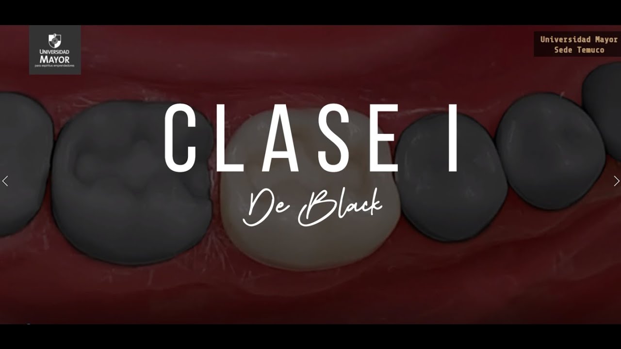 Preparación clase I de Black | Paso a paso