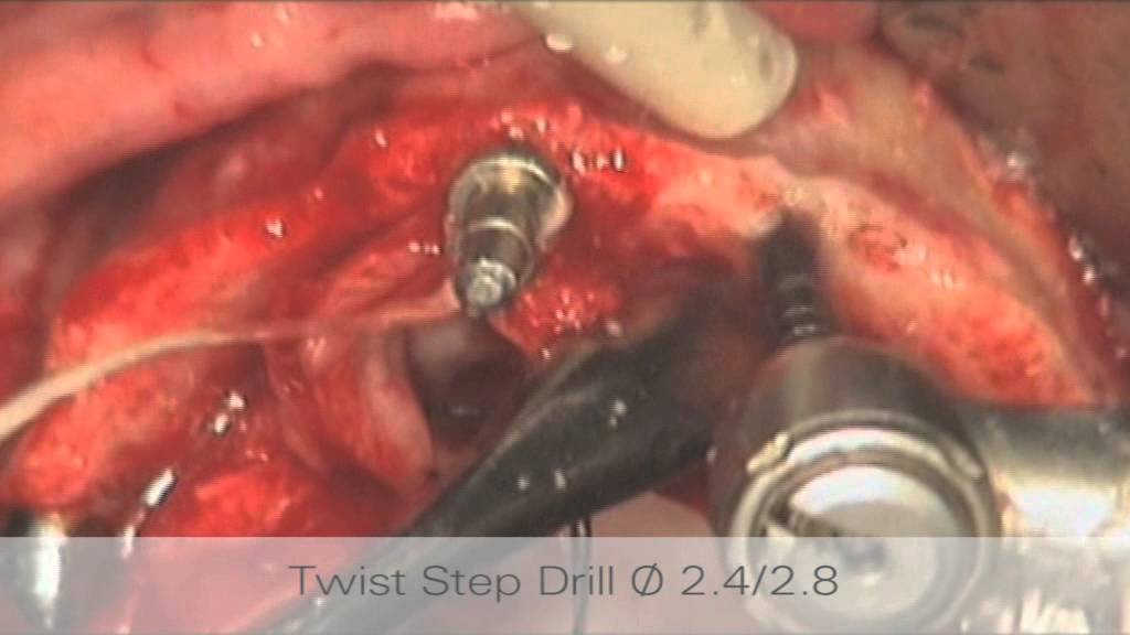 All-on-4&reg; patient case Paulo Malo | Nobel Biocare