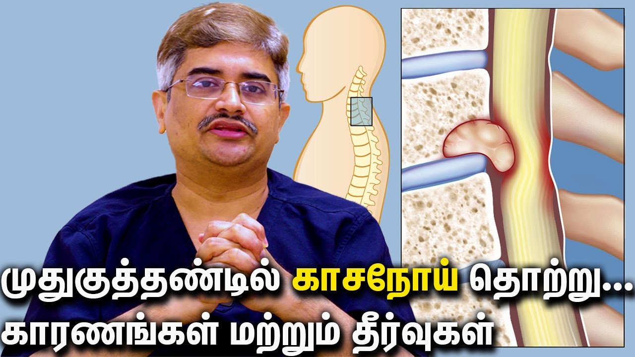 TB infection of Spine ...Causes and Remedies Dr.Roopesh Kumar