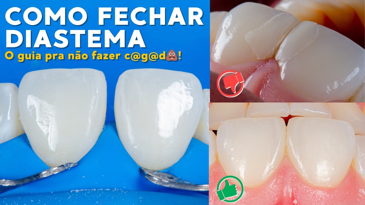 COMO FECHAR DIASTEMA: O guia pra não fazer c@g@d💩
